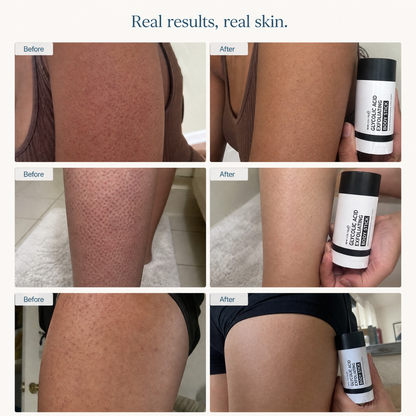 Avolei Bare Glycolic Acid For KP