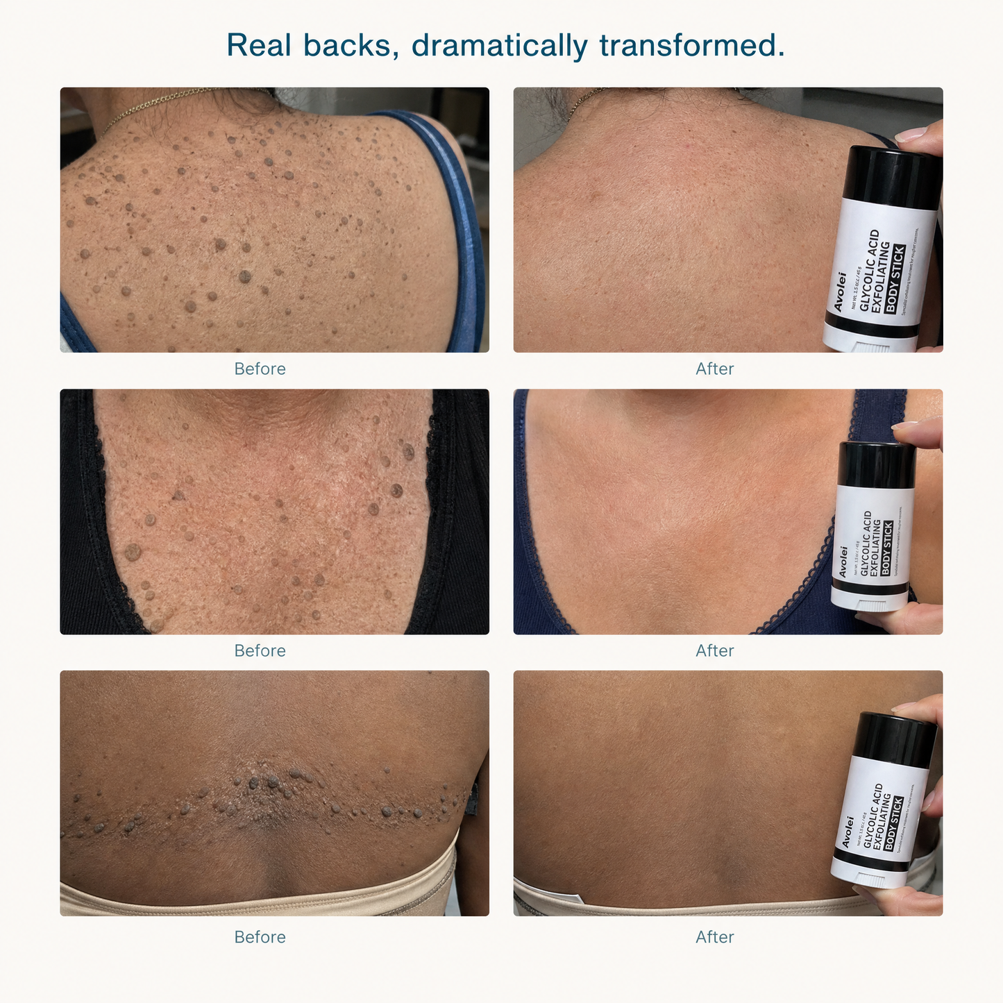 Avolei Bare Glycolic Acid For Body SK