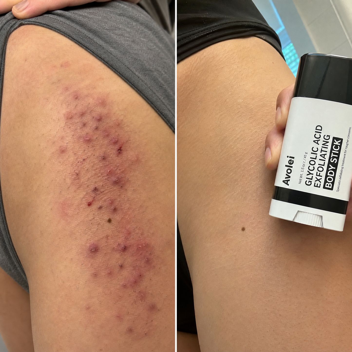 Avolei Bare Glycolic Acid For Ingrowns
